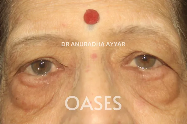 Ptosis Treatment at Oases Eye Care Center