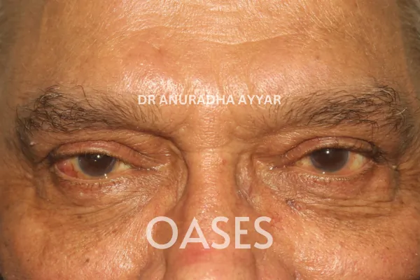 Blepharoplasty Treatment at Oases Eye Care Center