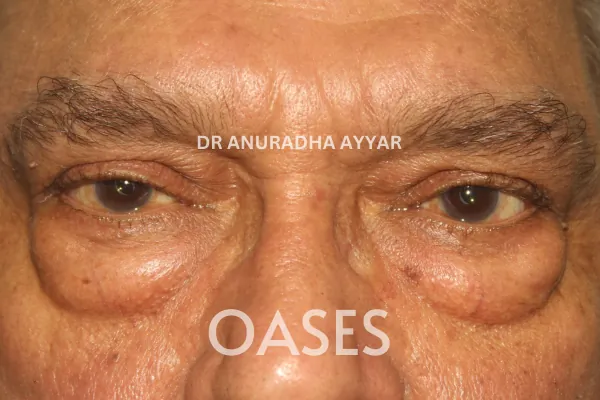Blepharoplasty Treatment at Oases Eye Care Center