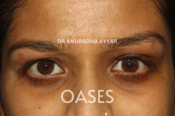 Blepharoplasty Treatment at Oases Eye Care Center