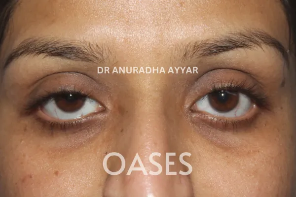 Blepharoplasty Treatment at Oases Eye Care Center