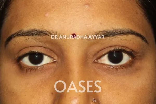 Ptosis Treatment at Oases Eye Care Center