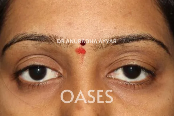 Ptosis Treatment at Oases Eye Care Center
