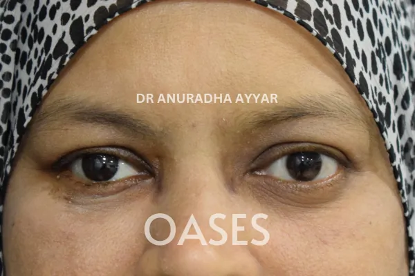 Blind Eye Cosmetic Rehabilitation Treatment at Oases Eye Care Center