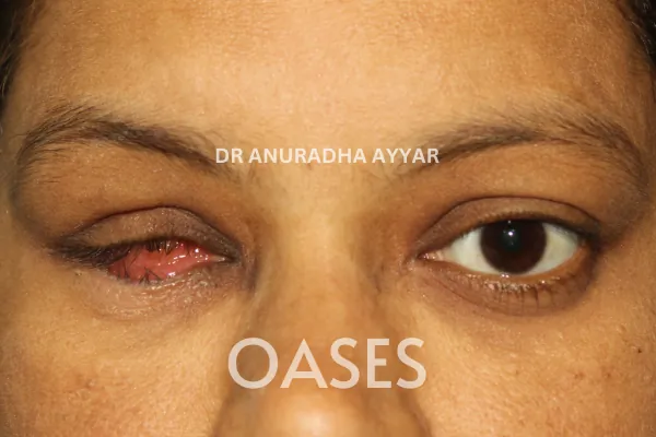 Blind Eye Cosmetic Rehabilitation Treatment at Oases Eye Care Center
