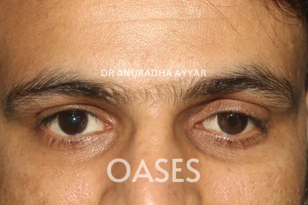Blind Eye Cosmetic Rehabilitation Treatment at Oases Eye Care Center