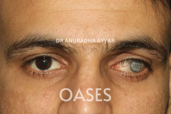Blind Eye Cosmetic Rehabilitation Treatment at Oases Eye Care Center