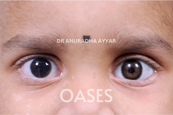 Blind Eye Cosmetic Rehabilitation Treatment at Oases Eye Care Center