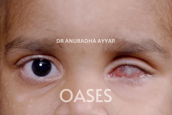 Blind Eye Cosmetic Rehabilitation Treatment at Oases Eye Care Center