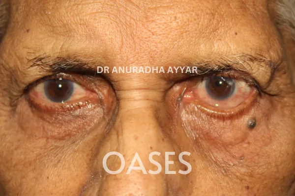 Facial Palsy Treatment at Oases Eye Care Center