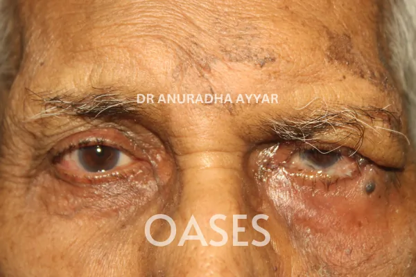 Facial Palsy Treatment at Oases Eye Care Center