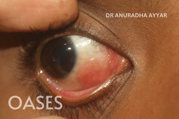 Infections Treatment at Oases Eye Care Center