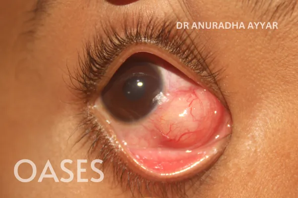 Infections Treatment at Oases Eye Care Center