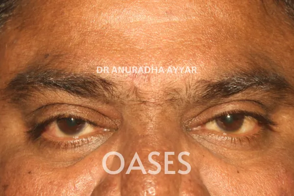 Infections Treatment at Oases Eye Care Center