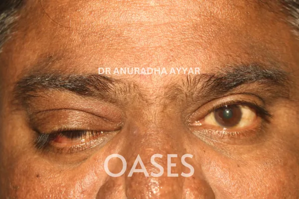Infections Treatment at Oases Eye Care Center