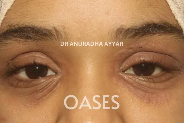 Infections Treatment at Oases Eye Care Center