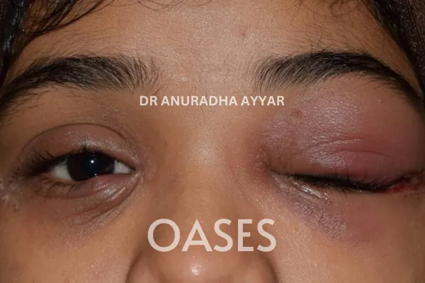 Infections Treatment at Oases Eye Care Center
