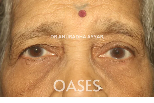 Ptosis – After Treatment