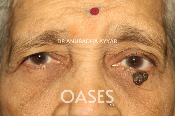 Ptosis – Before Treatment