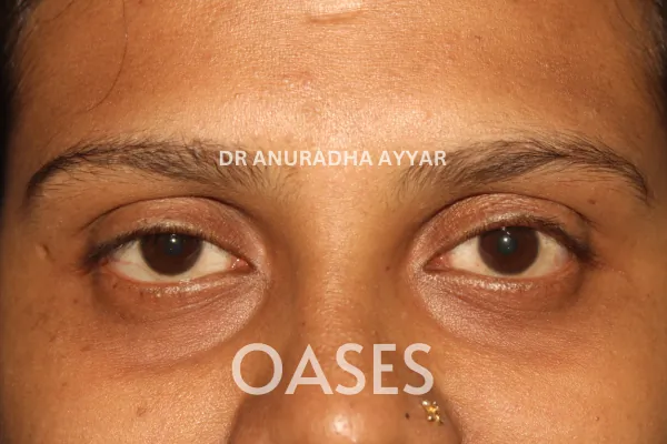 Lumps and Bumps Treatment at Oases Eye Care Center