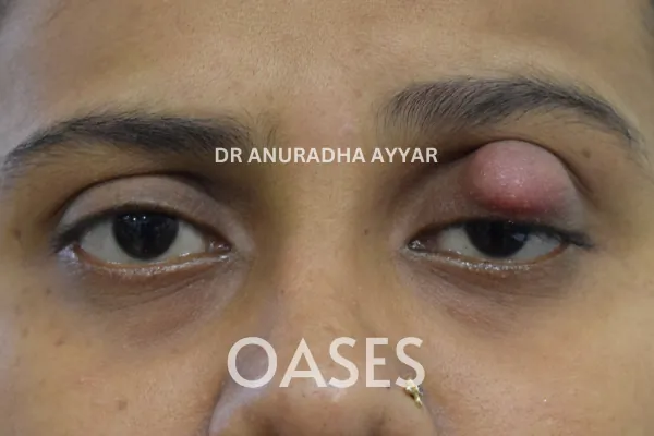 Lumps and Bumps Treatment at Oases Eye Care Center
