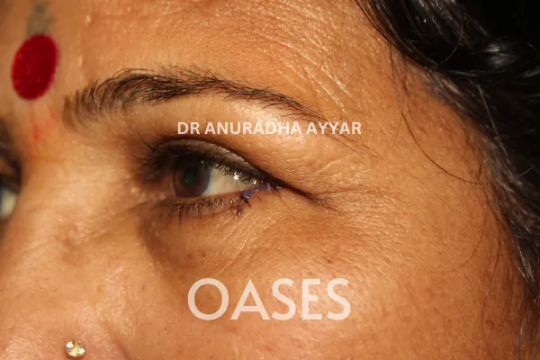Lumps and Bumps Treatment at Oases Eye Care Center