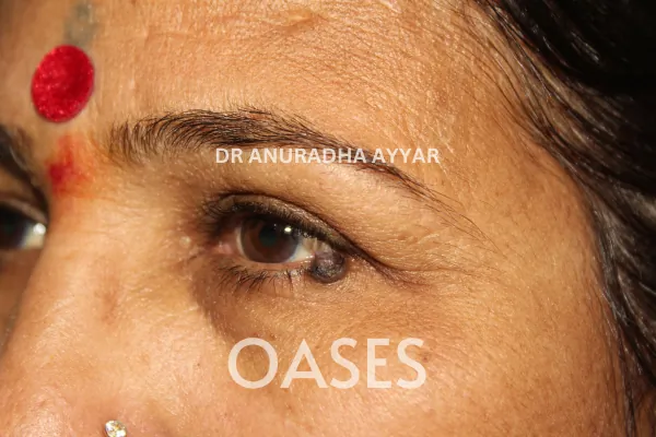 Lumps and Bumps Treatment at Oases Eye Care Center
