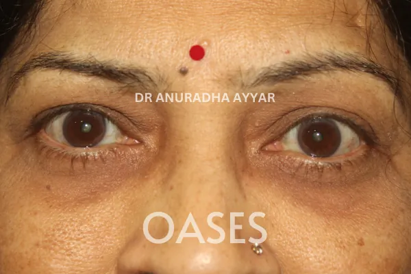 Ptosis Treatment at Oases Eye Care Center