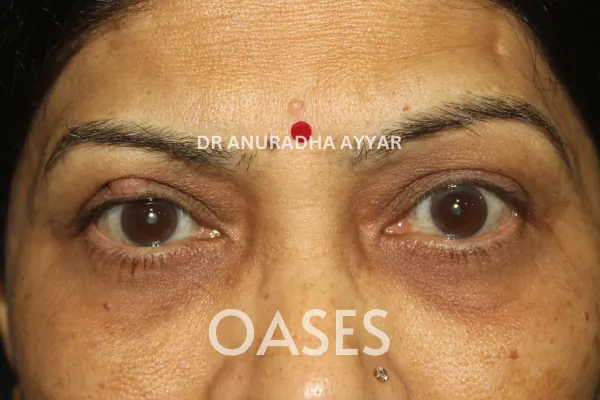 Ptosis Treatment at Oases Eye Care Center