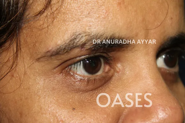 Ptosis Treatment at Oases Eye Care Center