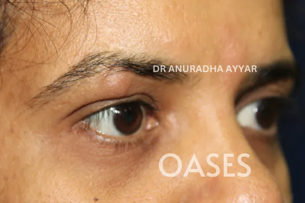 Ptosis Treatment at Oases Eye Care Center