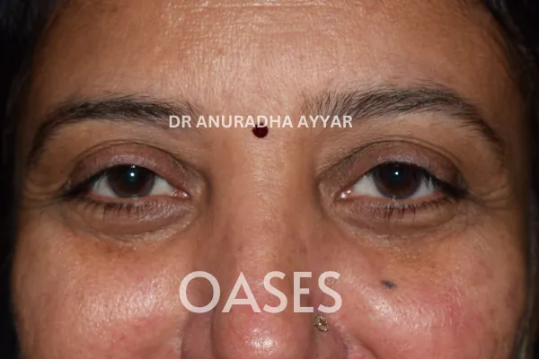 Ptosis Treatment at Oases Eye Care Center