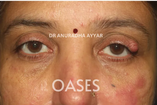 Ptosis Treatment at Oases Eye Care Center