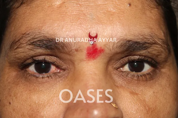 Ptosis Treatment at Oases Eye Care Center