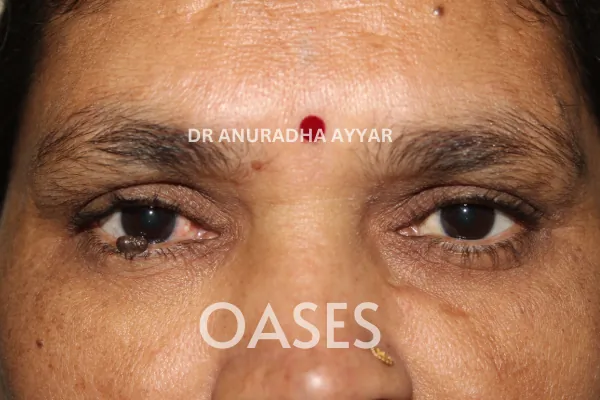 Ptosis Treatment at Oases Eye Care Center