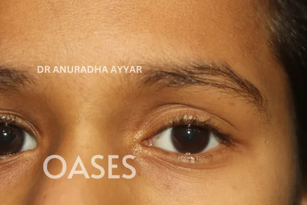 Ptosis Treatment at Oases Eye Care Center
