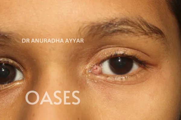 Ptosis Treatment at Oases Eye Care Center