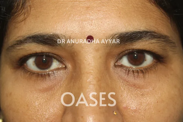 Ptosis Treatment at Oases Eye Care Center