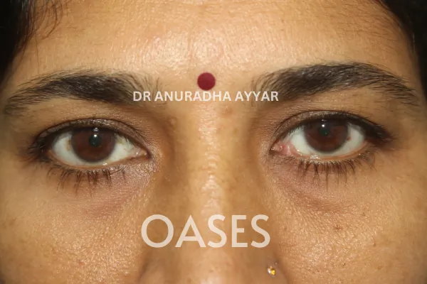 Ptosis Treatment at Oases Eye Care Center
