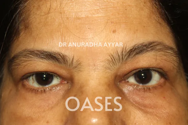 Eye-lid cancer Treatment at Oases Eye Care Center