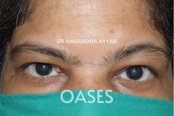 Eye-lid cancer Treatment at Oases Eye Care Center