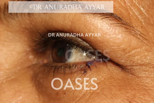 Eye-lid cancer Treatment at Oases Eye Care Center