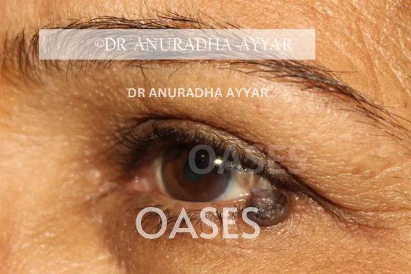 Eye-lid cancer Treatment at Oases Eye Care Center