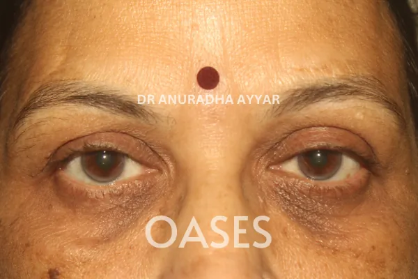 Eye-lid cancer Treatment at Oases Eye Care Center