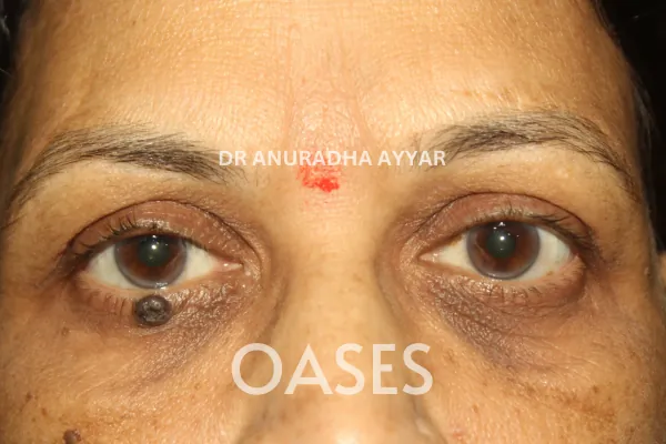 Eye-lid cancer Treatment at Oases Eye Care Center