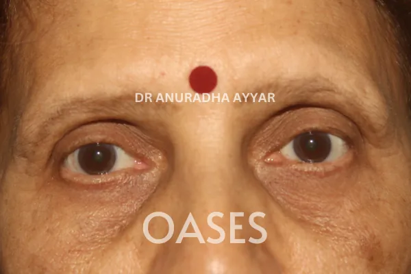 Eye-lid cancer Treatment at Oases Eye Care Center