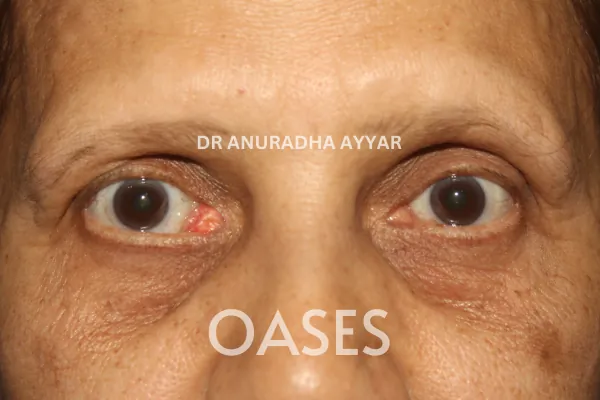 Eye-lid cancer Treatment at Oases Eye Care Center