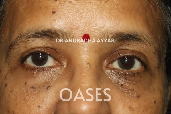 Eye-lid cancer Treatment at Oases Eye Care Center