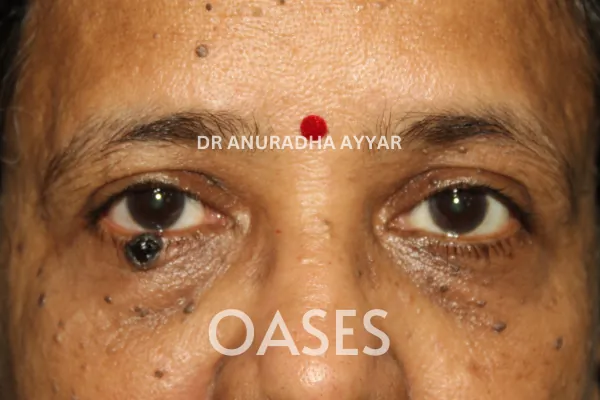 Eye-lid cancer Treatment at Oases Eye Care Center