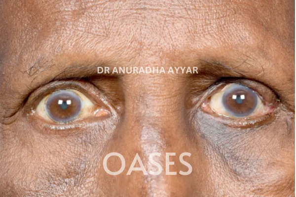 Eye-lid cancer Treatment at Oases Eye Care Center